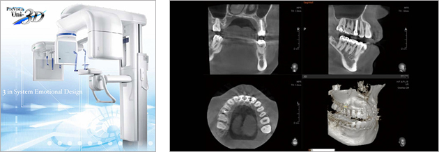 最新式の歯科用CT（Prevista Uni-3D）